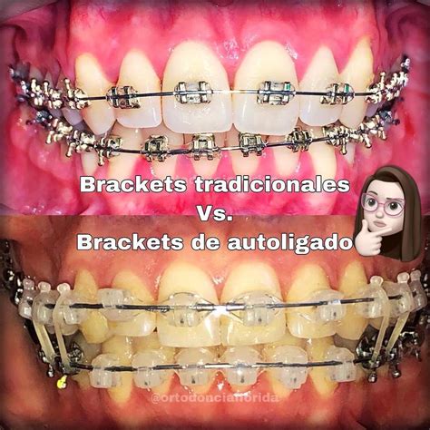 brackets metalicos y esteticos articulos|bracket autoligado vs convencional.